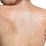 Struggling with Stubborn Back Acne?