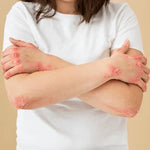 Psoriasis - Doctor Towels