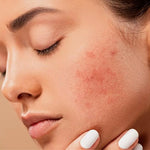 Breakouts Despite Your Skincare Routine?