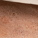 Eczema Flare-Ups & Dry Patches? Your Towel Might Be Making It Worse!