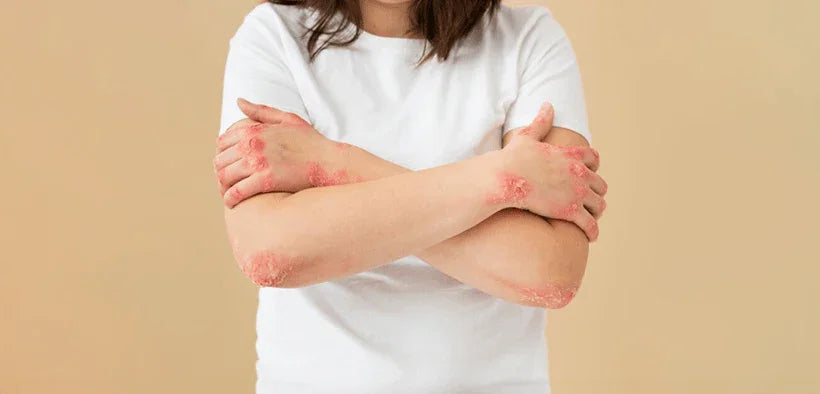Psoriasis - Doctor Towels