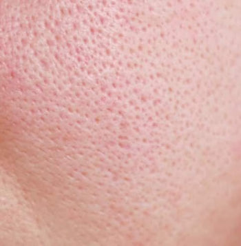 Clogged Pores